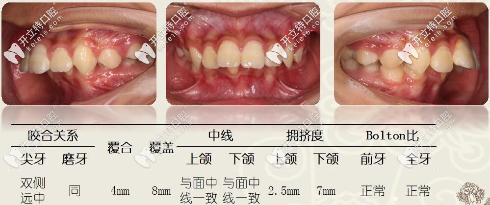 圣贝牙科，儿童矫治案例