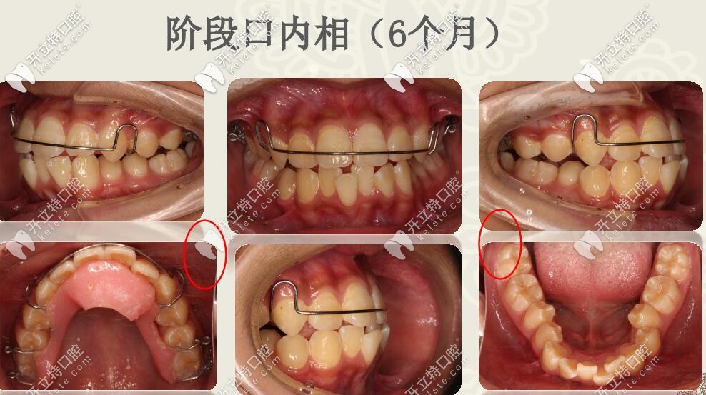 线圣贝口腔肌功能结合扩弓矫治案例