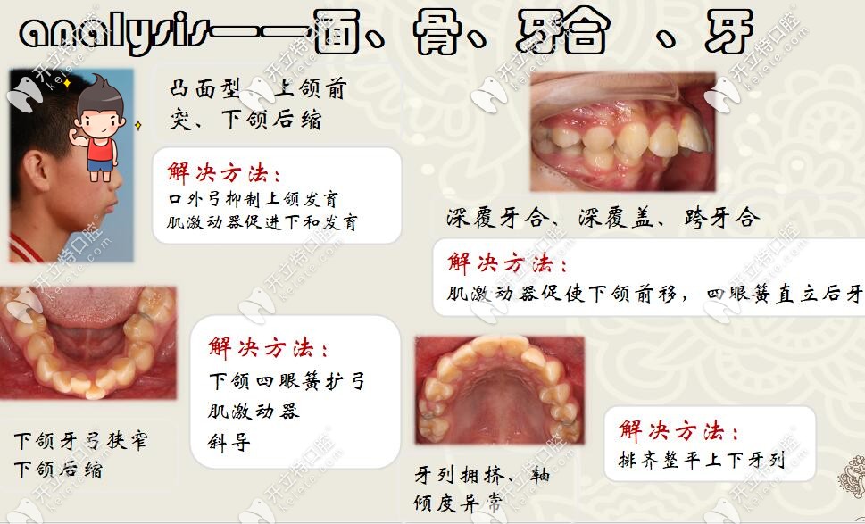 圣贝口腔何晓天医生龅牙矫治案例