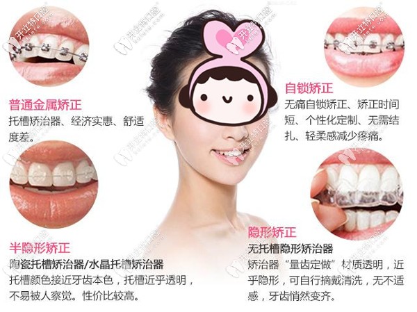 北京西尔口腔牙齿矫正分类