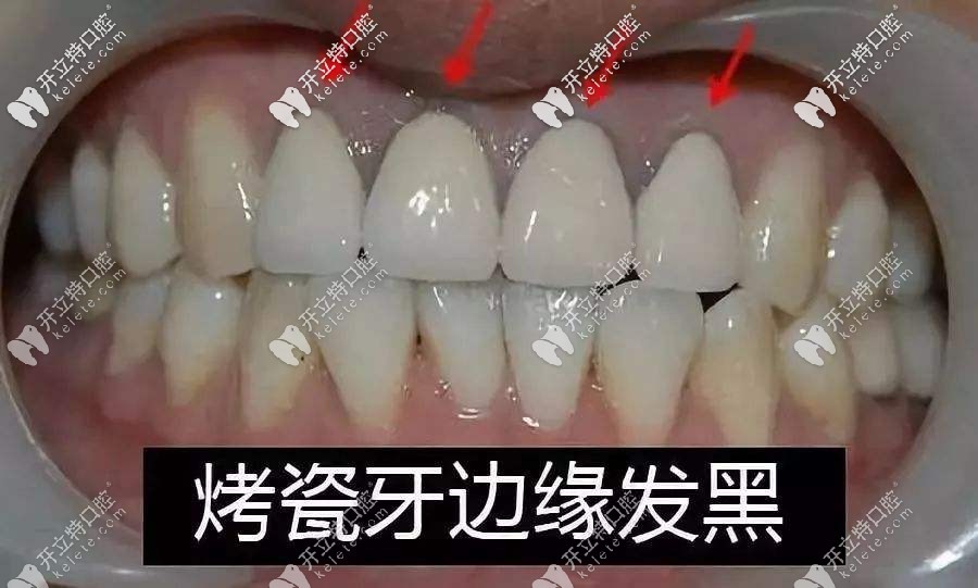 问题一:烤瓷牙冠边缘的牙龈黑线是什么原因呢?