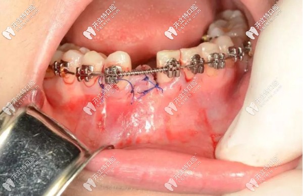缺牙修复和排齐牙齿可以同时进行吗