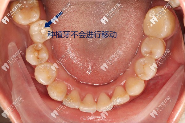 种植牙不会移动所以需先矫正后种植