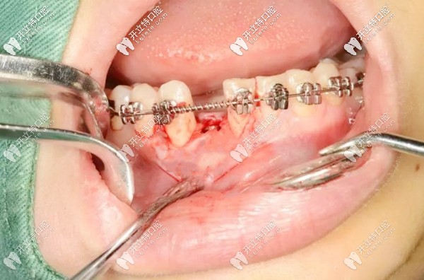 正畸过程中做种植牙的示意图