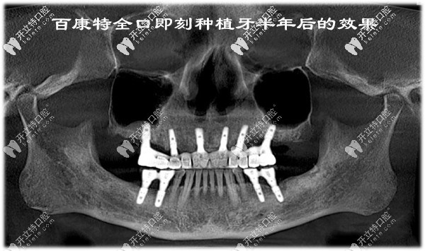 百康特全口即刻种植牙半年后的效果