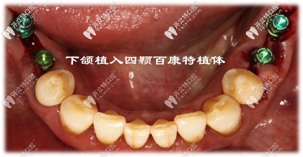 百康特即刻种植牙案例