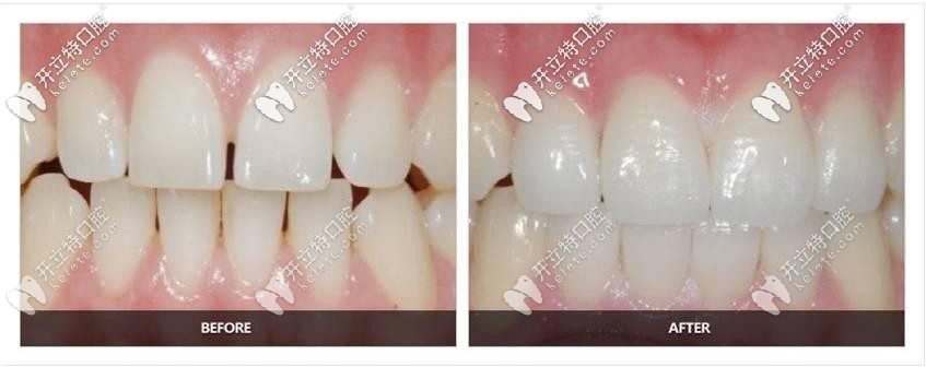 美莱口腔:黄丽琼医生—牙贴面修复案例 美莱口腔:黄丽琼医生—牙贴面修复案例