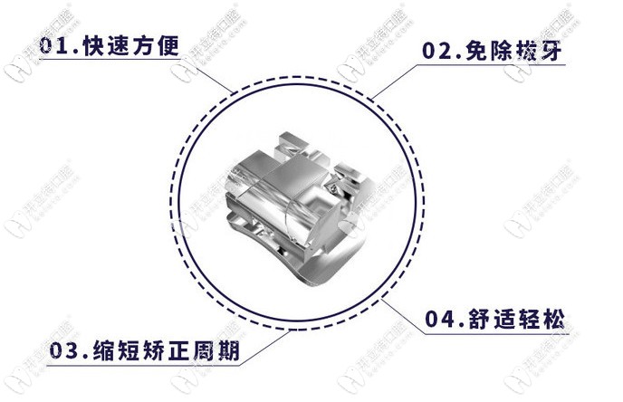 金属自锁托槽矫正