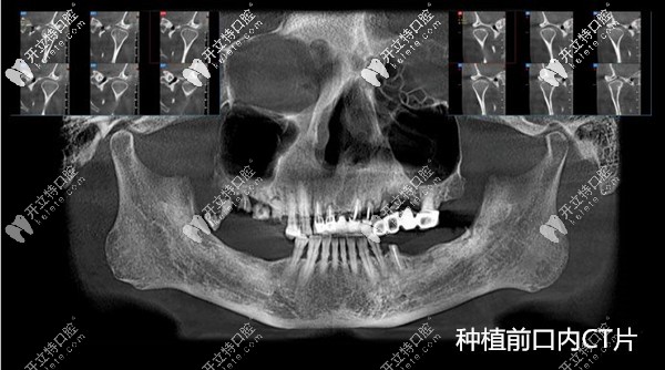 全口种植牙术前口内CT片