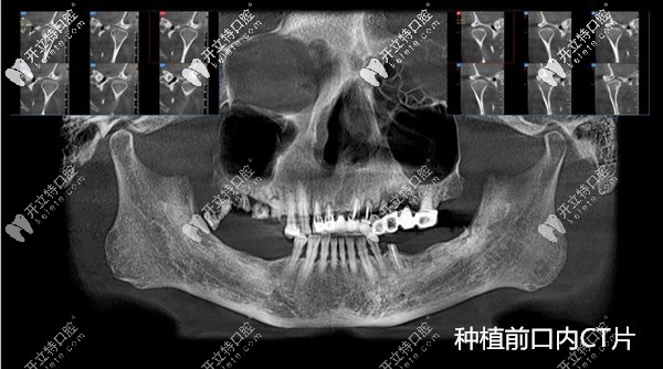 国产百康特种植牙质量不输进口,成功运用在全口即刻种植中