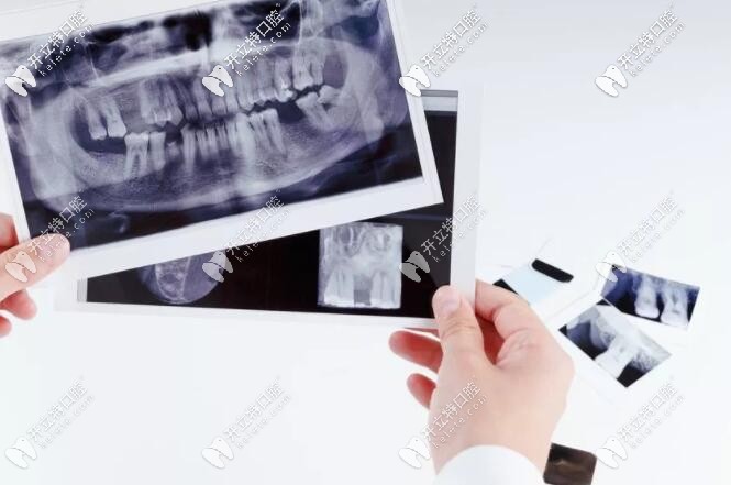 南宁柏乐口腔医生告诉你:看牙为啥要拍片子？辐射大吗？