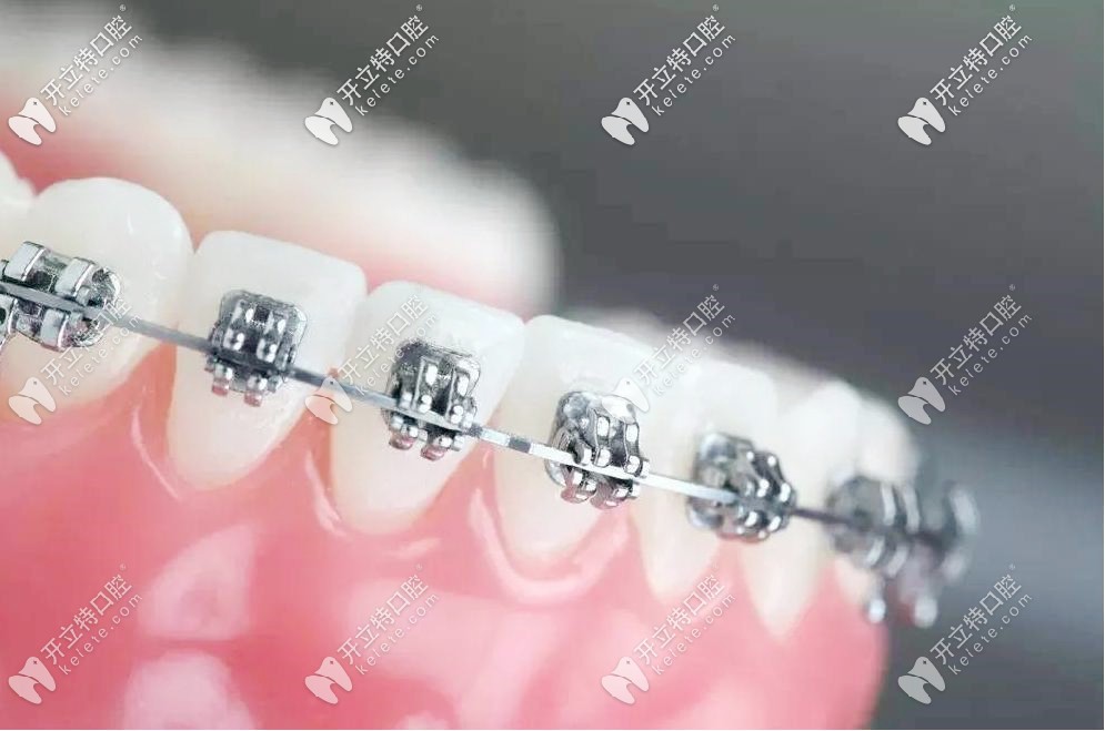 gac自锁托槽是哪里产的，用gac自锁牙套矫正到底好不好？