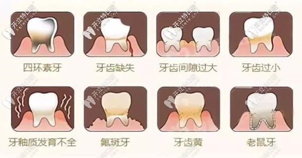 合肥贝杰口腔全瓷贴面修复的优点 合肥贝杰口腔全瓷贴面修复的优点