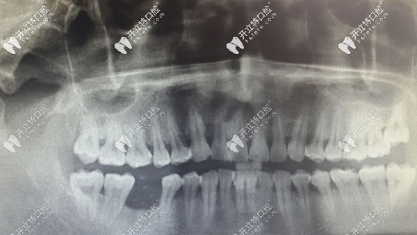 被拔除后牙齿牙窝有脓液