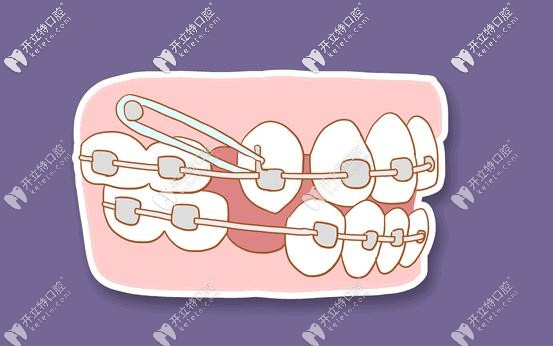 正畸期间常见的移动方式是什么,矫正也会移动牙根吗？