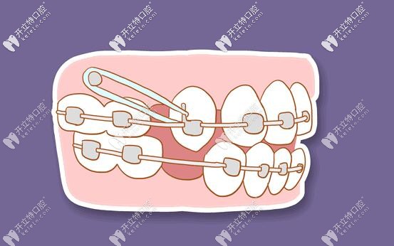 正畸移动牙齿