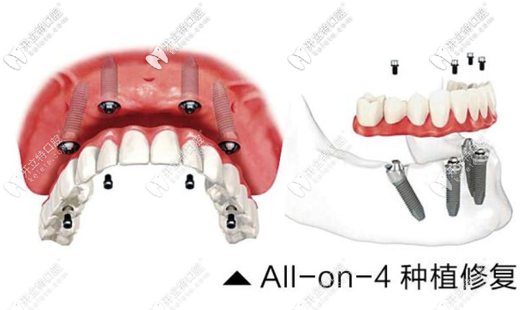 Allon4即刻种植牙