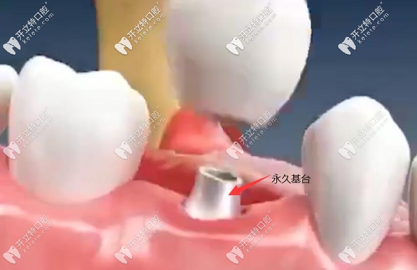种牙三期戴永 久基台和牙冠过程