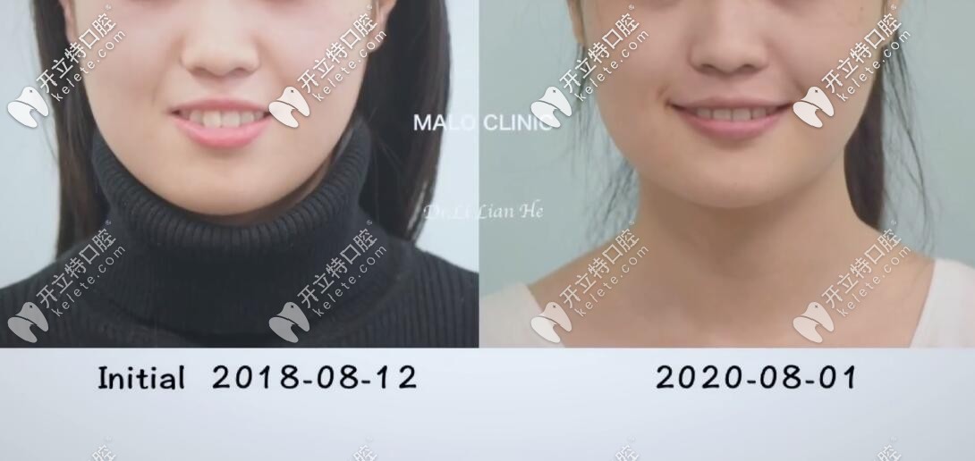 龅牙矫正前后我的脸型对比图