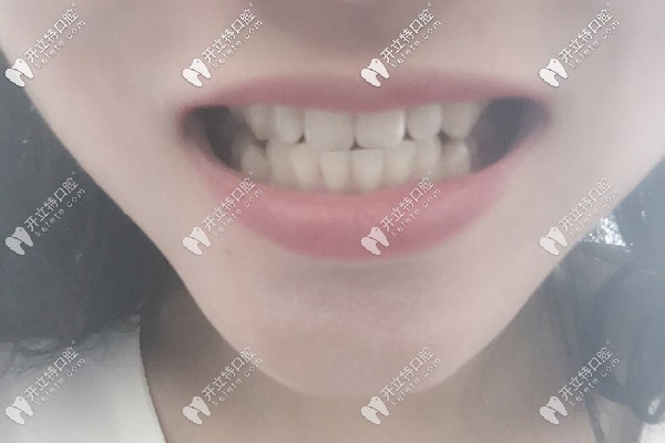 牙齿做完牙冠后的照片