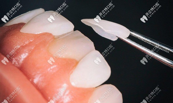 琥珀瓷牙贴面价格多少钱一颗， 与树脂牙贴面对比哪个好？