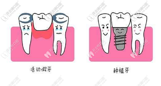 牙齿缺失的修复方式