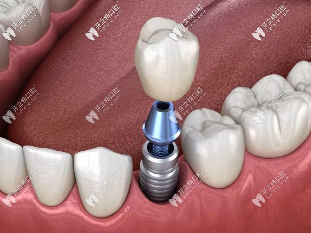 解剖口腔种植牙二期上基台的步骤流程，手术过程要多久？