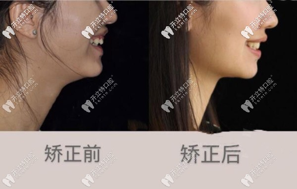 标准牙齿的侧面图图片