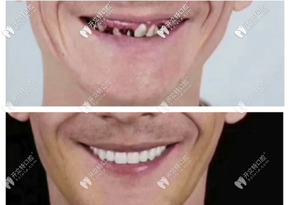 半口种植6颗牙根的效果图