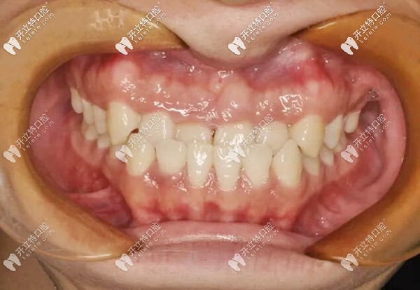 前牙反颌+偏颌矫正案例:戴进口自锁牙套也可以解决嘛
