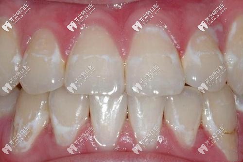 孩子做正畸后牙齿脱矿还有救吗？白斑到底能不能消除？