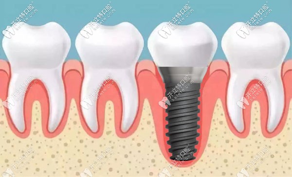 种植牙在牙槽骨中的展示图