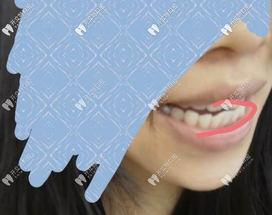 牙齿矫正反弹
