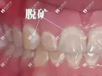 牙釉质脱矿的原因