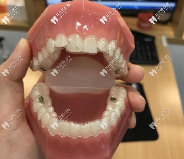 隐适美矫正牙套 