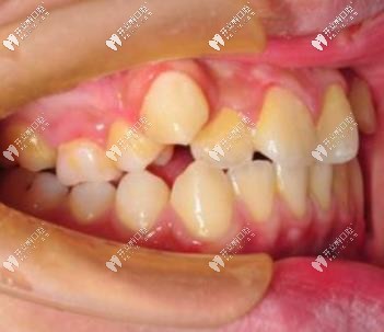 矫正前的牙齿情况