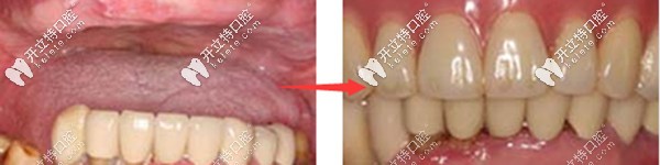太原众牙口腔半口种植牙的案例