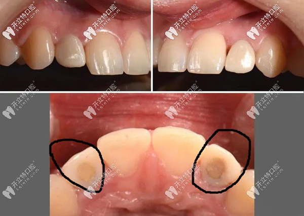 前牙美学区即刻种植牙修复1个月后