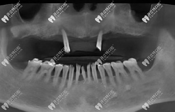 CT片显示牙槽骨重度萎缩