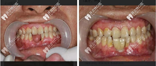 合肥贝杰口腔即拔即种案例 合肥贝杰口腔即拔即种案例
