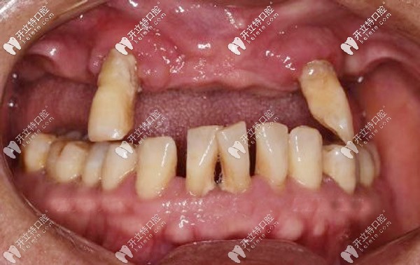 上颌长期缺牙导致牙齿脱落