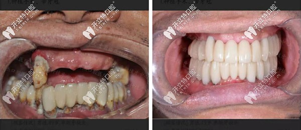合肥贝杰口腔全口种植牙案例