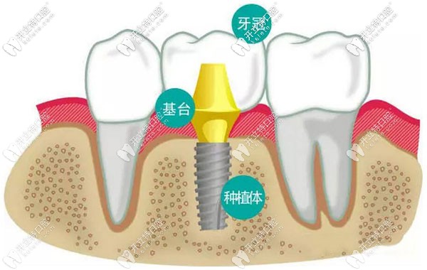 花1万元在乌鲁木齐小白兔口腔做一颗种植牙的亲身感受