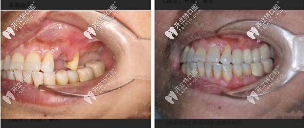 合肥贝杰牙科多颗牙种植案例