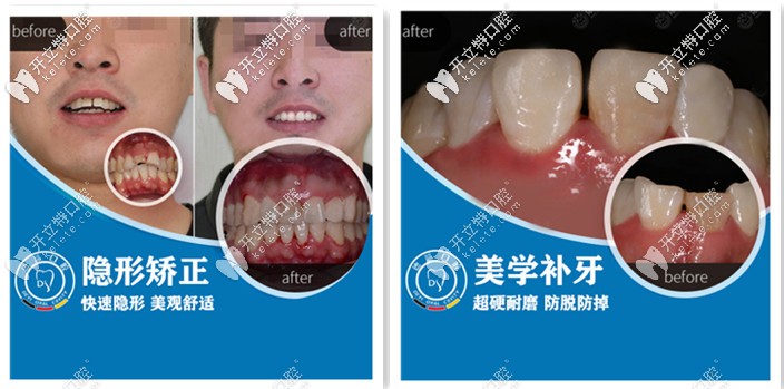 德益口腔-牙齿矫正和补牙案例展示