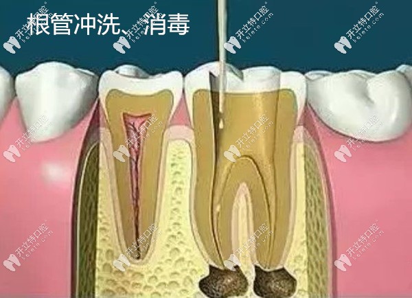 根管治疗步骤二根管消毒