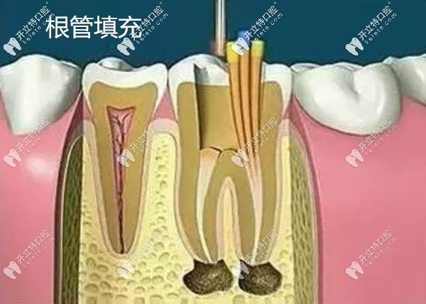 根管治疗步骤三根管填充