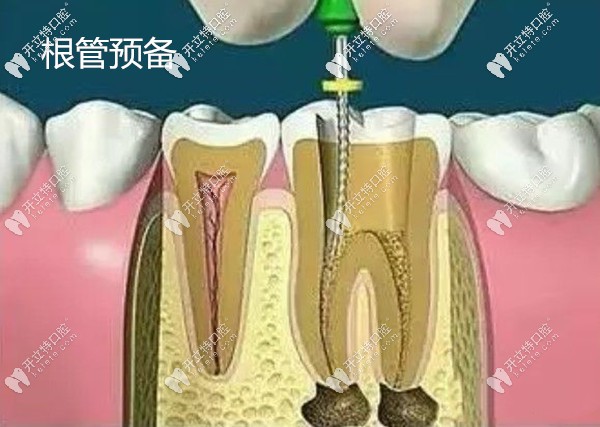 根管治疗步骤一根管预备