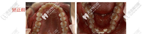 矫正前上颌下颌图