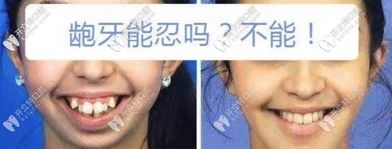龅牙凸嘴矫正前后对比图 龅牙凸嘴矫正前后对比图
